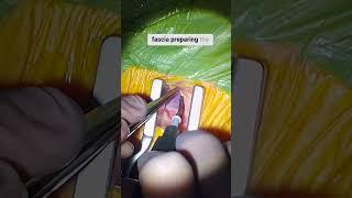 Femoral Cannulation for CPB During Minimally Invasive Cardiac Surgery #cardiac #bypass