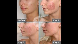 Acne Treatment with Fractional Resurfacing, Before and After