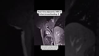 Real-time (dynamic) MRI of infant breastfeeding