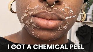 VLOGTOBER Day 3: I got a Chemical Peel for hyperpigmentation VI Peel ft luxmodeaesthetics