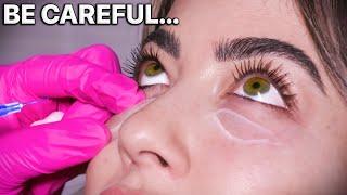 The Truth Behind Under Eye Filler | Nurse Reacts