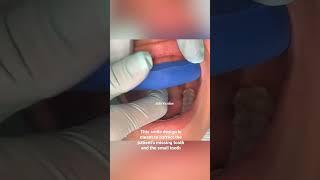 Dental veneer procedure | dental veneers step by step | dental veneers for gapped teeth | Dr. Yazdan