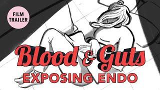 BLOOD & GUTS: Exposing Endo [Trailer]