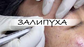 ПРЫЩИ  ПРЫЩИ ВЫДАВЛИВАНИЕ  ПОДБОРКА ВЫДАВЛИВАНИЕ ПРЫЩЕЙ #прыщи #acne #asmr