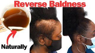 These 3 Herbs Will Help to Reverse Baldness and Hair Thinning.Try NOW! and See What Happens.