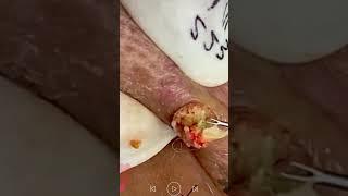 Skincare | Blackheads Removal #492 #tweezers skincare #blackheads blackheads