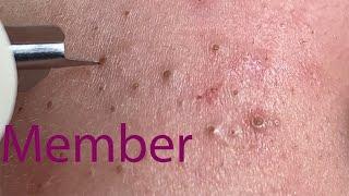 Acne Treatment Huong Da Nang# 039 |  member | 2023