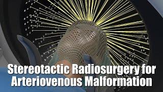 Stereotactic Radiosurgery for Arteriovenous Malformation (AVM)