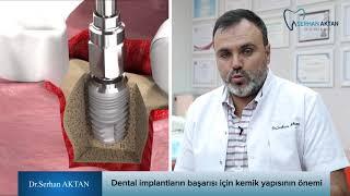 Dental implantların başarısı için kemik yapısının önemi