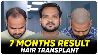 Hair Transplant in Bangladesh | Best Results & Cost of Hair Transplant in Bangladesh