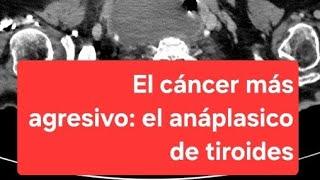 El cáncer anáplasico de tiroides. El tumor más agresivo del ser humano.