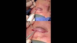 Blepharoplasty "Eyelid Lift" by Plastic Surgeon Dr Kevin Sadati in Newport Beach, Orange County