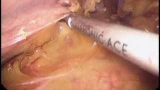 Sleeve Gastrectomy By WAEL TOBAR MD
