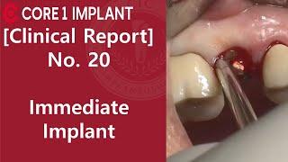 [CYBERMED Clinical Report] #15 Immediate implant