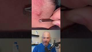 Derm reacts to infected ingrown hair! #dermreacts #doctorreacts #ingrownhair
