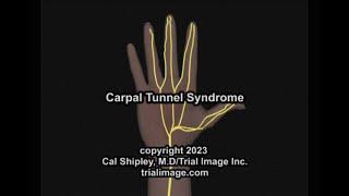 Carpal Tunnel Syndrome by Cal Shipley, M.D.