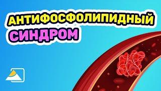 Причины невынашивания беременности: АФС-синдром