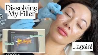 I Dissolved My Filler...AGAIN! Ultrasound-Guided Filler Dissolving Process