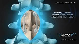 Orthofix: JANUS Midline Fixation Screw