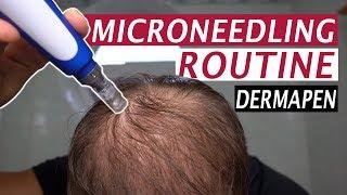 My Microneedling Routine and Derma Rolling for Hair Loss!