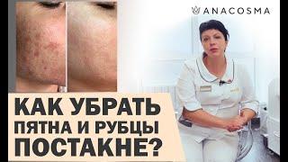 ПОСТАКНЕ  КАК УБРАТЬ ПЯТНА И РУБЦЫ ПОСЛЕ ВЫСЫПАНИЙ? | Федоряченко Оксана