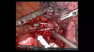 Cerfolio Tips: How to Repair major PA injury Robotically, without Opening or Transfusing Patient