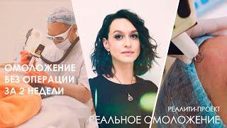 Омоложение лица БЕЗ ОПЕРАЦИИ за 2 НЕДЕЛИ [Линлайн Сеть клиник]
