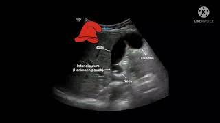 Learn Anatomy of Gall bladder on ultrasound at a glance.