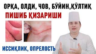 ИШТОН ИЧИ, ҚЎЛТИҚ, ЧОТ ПИШИБ КЕТИШИ, ИССИҚЛИК ТОШМА ЧИҚИШИ САБАБИ, АСОРАТИ ВА ДАВОСИ ХАҚИДА ИСЧАНОВ