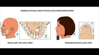 Localizing Palatal and Lingual Canine Impactions- Occlusal X-Rays