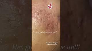 Effective method for removing deep acne scars