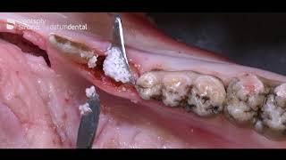 Socket preservation demonstration using Bone Graft & OSSIX® Plus