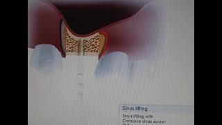 Sinus lift video :using MIS-Implants Bone compression kit