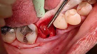 The Truth About Wisdom Teeth Removal