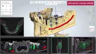 3D BioCAD - 3Shape Implant Studio Step by Step Guide