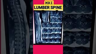 MRI LUMBER SPINE FILMING @hemantkushwah3453 #mriscan #radiology #lumber #spine #back #shorts