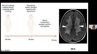 2022 Symposium Early Signs and Symptoms of Leukodystrophies presented by Maura Ruzhnikov