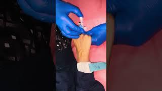 I V Cannula insertion method #nurse #hospital #doctor #reels #views #shorts #share #world #feed