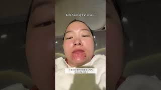 How my acne is treated at the dermatologist!