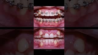 Braces process