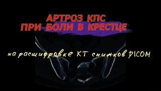 АРТРОЗ крестцово-подвздошных сочленений и БОЛИ В КРЕСТЦЕ после САКРОИЛЕИТА на РАСШИФРОВКЕ КТ