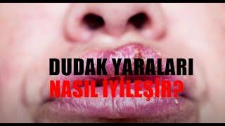 Dudak yaraları nasıl geçer? İşte bitkisel yöntemler