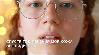 Как я вылечила акне | Большое подробное видео (часть 1)