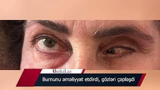 Sumqayıtda həkim səhlənkarlığından qadının gözləri çəpləşdi