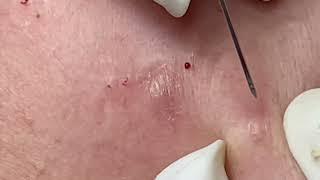 Acne Treatment New 2025 | Blackheads & Whiteheads Removal  Mimi channel 020