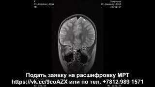 Второе мнение МРТ расшифровка головного мозга у ребенка 6 лет без патологий