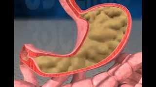 gastric reflux animation