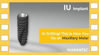 [warantec] IU Drilling! This is How You Do on Maxillary Molar