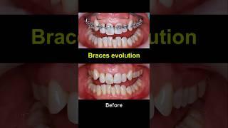 Braces evolution 2022-2025 #braces #dentist #orthodontist #teeth