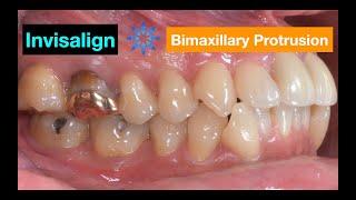 Treatment of Bimaxillary Protrusion with Invisalign｜【Chris Chang Ortho】CC736